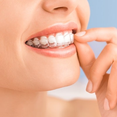 Close up of a woman putting on her Invisalign clear aligners
